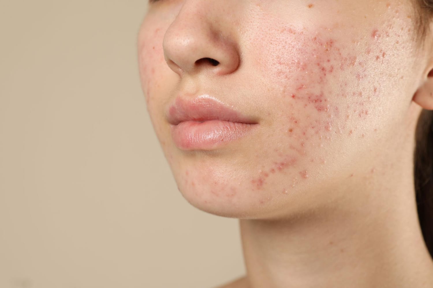 skin breakout
